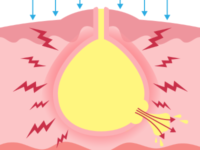 感染性粉瘤イラスト